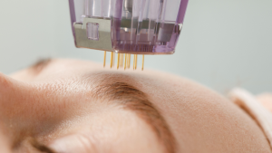 microneedling vs laser treatments which skin rejuvenation option is best for you
