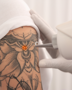 laser tattoo removal