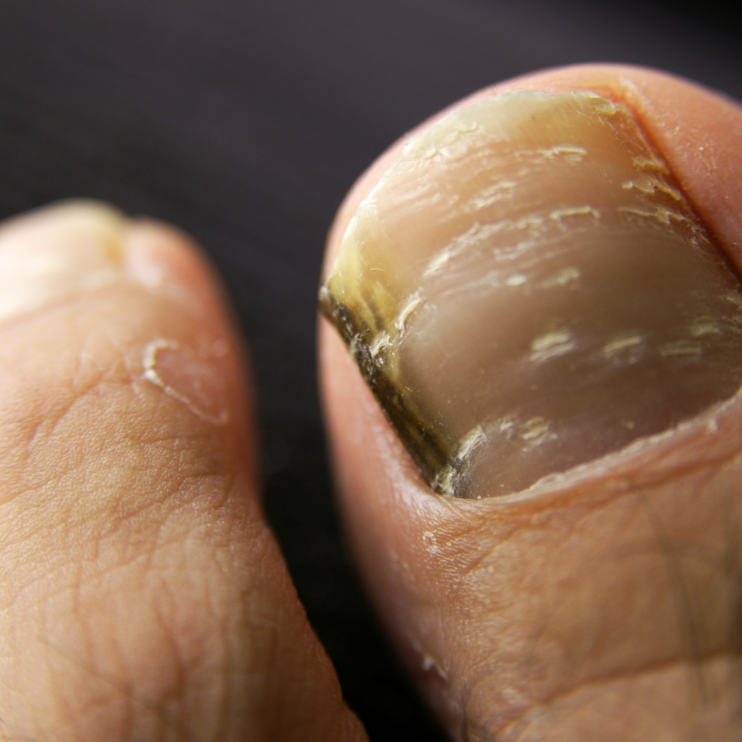 toenail fungus treatment - Reborn Aesthetics & Wellness toenail fungus treatment