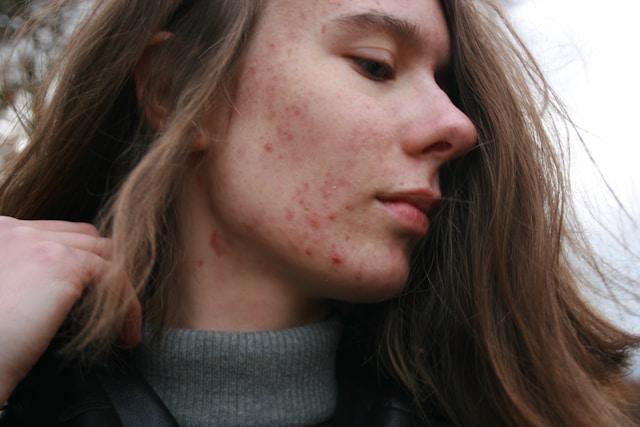 best treatment for acne in 2026