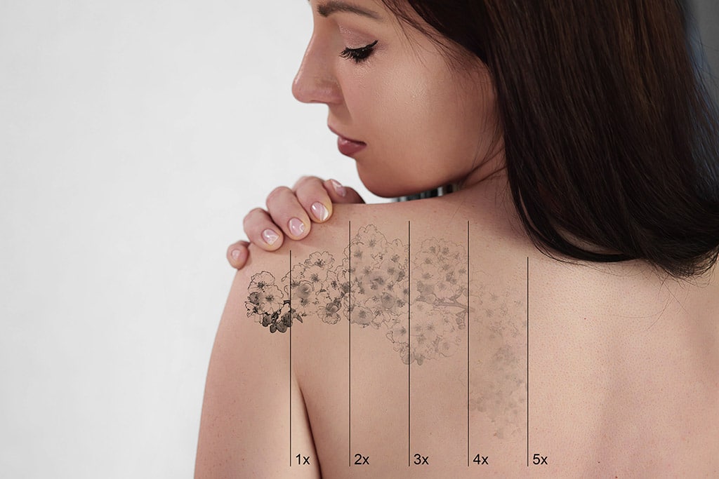Laser Tattoo Removal: How Modern Laser Technology Can Help You Remove Unwanted Ink